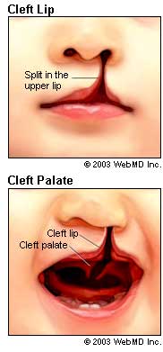 dental_health_cleft_lip_cleft_palate_cleft_lip